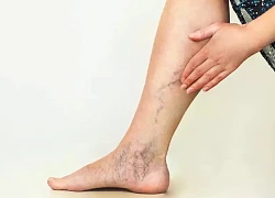 Biến chứng nguy hiểm của bệnh giãn tĩnh mạch
