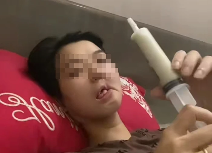 Hình ảnh cô gái mắc ung thư xương hàm, bữa ăn hàng ngày là "cháo xay loãng ăn bằng xi lanh" gây xót xa: Dấu hiệu phát hiện bệnh sớm trước khi quá muộn