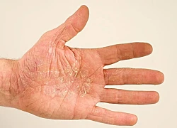 Nổi mẩn, bong tróc da cảnh báo bạn có thể mắc viêm gan B