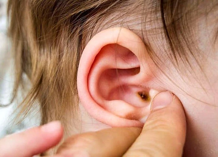 Dấu hiệu nhận biết viêm ống tai ngoài