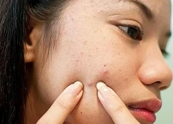Sau nặn mụn không nên ăn gì?