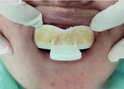 Cô gái 24 tuổi suýt ngạt vì tự làm hàm giả bằng thạch cao mua trên mạng