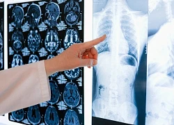 HLV thể hình ăn uống kỷ luật vẫn bị ung thư, bác sĩ chỉ ra thói quen nguy hại