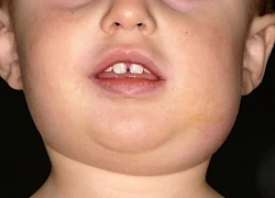 Một người có thể mắc quai bị hai lần không?