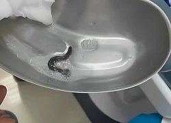 Phát hiện đỉa trong đường thở của bệnh nhi 5 tuổi ở tỉnh Đắk Lắk