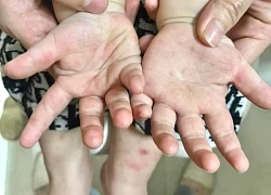 Phòng, chống dịch bệnh cho trẻ trong mùa nắng nóng