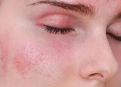 Sử dụng kem chống nắng giả nguy hiểm như thế nào?
