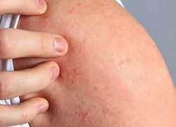 Dị ứng thức ăn có thể gây sốc phản vệ nguy kịch