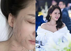 Sốc nặng hình ảnh Trần Kiều Ân cắm hàng trăm chiếc kim khắp cơ thể, làm đẹp mà chấp nhận đau đớn không tưởng!
