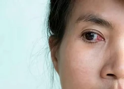 5 biến chứng nguy hiểm nếu bạn đeo kính áp tròng quá lâu