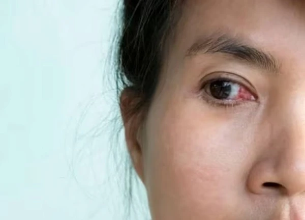 5 biến chứng nguy hiểm nếu bạn đeo kính áp tròng quá lâu