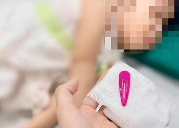 Thót tim gắp chiếc kẹp tóc sắc nhọn dài 5 cm trong dạ dày bé gái