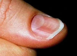 Nếu móng tay có dấu hiệu này, cẩn thận với ung thư hắc tố