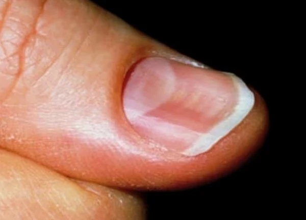 Nếu móng tay có dấu hiệu này, cẩn thận với ung thư hắc tố