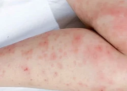 Cảnh báo gia tăng các bệnh về da trong mùa mưa