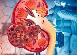 Dấu hiệu nhận biết ung thư thận