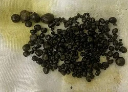 Gần 400 viên sỏi trong túi mật người phụ nữ
