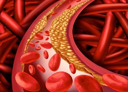 Thời điểm ăn tối có thể khiến mỡ bám vào mạch máu nhiều hơn
