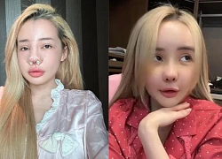 Ngân 98 nhập viện vì mũi viêm sau 11 lần sửa, sau 2 ngày quyết tháo băng đi diễn