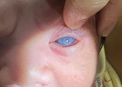 Phát hiện bệnh cực kỳ hiếm gặp ở bé sơ sinh sau chào đời 10 giờ tuổi