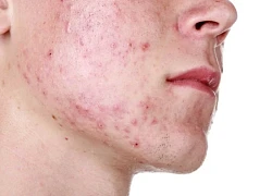 Nguyên nhân gây mụn trứng cá mà nhiều người bỏ qua