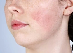 7 tác dụng phụ thường gặp khi sử dụng retinol và cách phòng ngừa