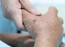 Bị ong vò vẽ đốt 30 mũi, cụ ông sốc phản vệ, phải lọc máu liên tục