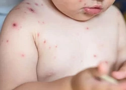 Căn bệnh quen thuộc có thể cướp sinh mạng trẻ sơ sinh trong vài ngày