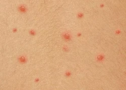 Cẩn trọng với bệnh thủy đậu gây biến chứng