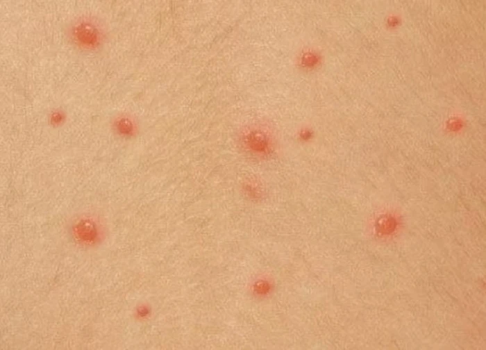 Cẩn trọng với bệnh thủy đậu gây biến chứng