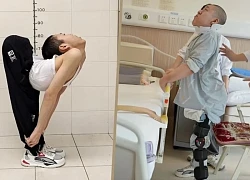 Chàng trai có cột sống gập hình chữ Z lần đầu đứng thẳng sau nhiều ca phẫu thuật