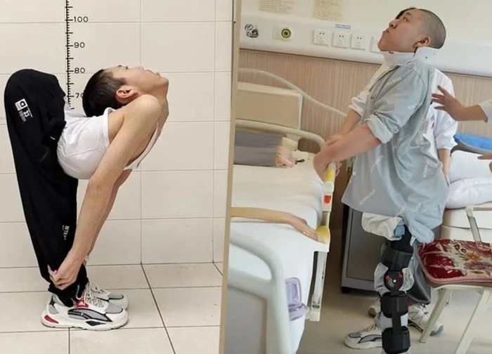 Chàng trai có cột sống gập hình chữ Z lần đầu đứng thẳng sau nhiều ca phẫu thuật