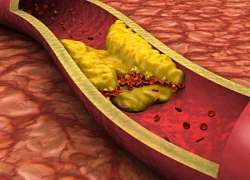 Cách để biết bị tăng Cholesterol và Triglycerid