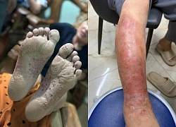 Cẩn trọng với bệnh vùng lũ: Một vết ngứa nhỏ có thể thành ổ nhiễm trùng