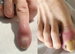 Người đàn ông bất ngờ phát hiện bị "ăn mất" ngón tay sau 6 tuần sưng đỏ