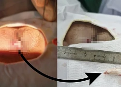 Người đàn ông suýt mù vì bị... gà trống nhảy lên đá vào mặt