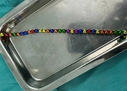 Nuốt nhiều mảnh nam châm, bé trai bị thủng ruột