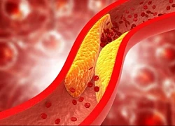 Rối loạn mỡ máu đang trẻ hóa