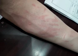 5 dấu hiệu buổi tối cho thấy có thể bạn đã nhiễm ký sinh trùng