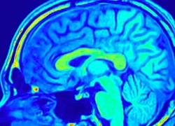 AI tạo bước đột phá quan trọng trong chẩn đoán ung thư