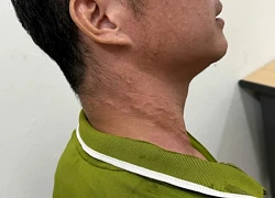 Bệnh giun rồng là gì, có nguy hiểm không?