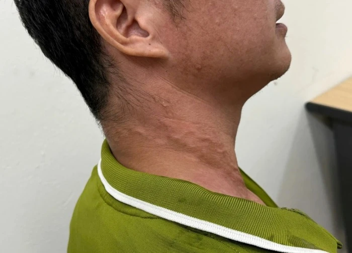 Bệnh giun rồng là gì, có nguy hiểm không?