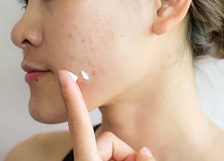 Bôi kem đánh răng có giúp điều trị mụn trứng cá?