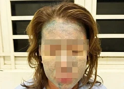 Nguy kịch vì dùng thuốc giảm cân, collagen 'xách tay'
