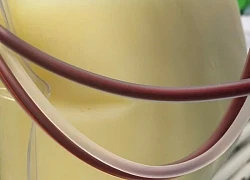 Người phụ nữ nặng 45kg có chỉ số mỡ máu cao gấp 37 lần bình thường