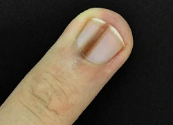 Ung thư móng dễ bị bỏ qua