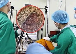 2 năm uống trà giảm cân, người đàn ông &#8216;xanh mặt&#8217; khi nội soi ruột?