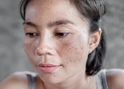7 vấn đề về da mùa hè có thể ngăn ngừa