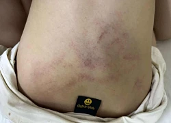 Bé gái bị đánh, kéo lê ở trường mầm non Hà Nội: Tạm đình chỉ giáo viên chứng kiến nhưng mặc kệ