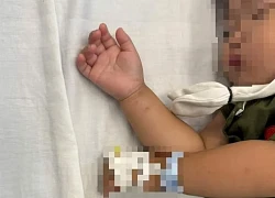 Bé gái hơn 2 tuổi nhập viện gấp do tai nạn tại nhà hay gặp ở trẻ nhỏ
